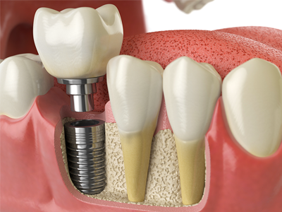 Implant dentaire unitaire